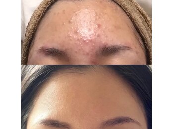 シャイネル(SHYNELL)/ハーブリプロ3回のお写真です!