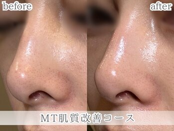 ミック(Mecc)/MTメタトロン肌質改善コース60分