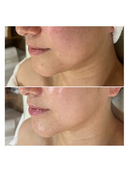 エクラ(eclat)/フェイスラインたるみケア