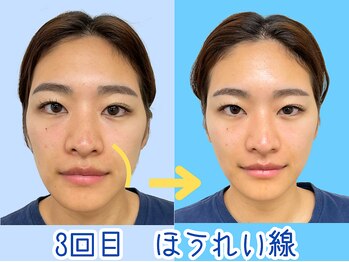 ナチュラルパーフェクトフェイス 新宿/3回目・ほうれい線/新宿小顔