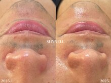 シャイネル(SHYNELL)の雰囲気（ニギビや毛穴ケアにも特化。男性にもオススメ☆）