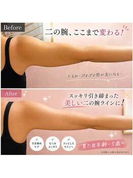 キャンディ 海老名駅前店(Candy)の写真/年齢とともに気になる二の腕のたるみ・ぷよぷよを引き締め美しいラインへ　マイクロ波リフト/海老名/韓国