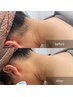 【第一印象UP】うなじデザイン脱毛　¥3500