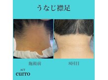 アクト クロ(ACT curro)/【うなじ襟足】脱毛施術例