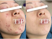 キー(kii)/長年お悩みのニキビに働きかける