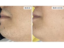 トパーズ 掛川店(Topaz)/メンズ脱毛　ひげ脱毛