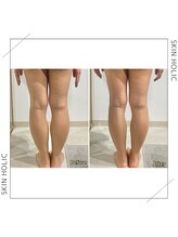 スキンホリック 恵比寿駅前店(SKIN HOLIC)/脚☆ビフォア＆アフター★