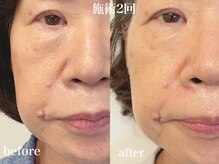 エンソワー(en'sower)/美白への第一歩！