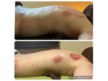 No.3(three)の雰囲気(カッピング9回目の変化!巻肩、猫背で曲がった背中も改善へ)