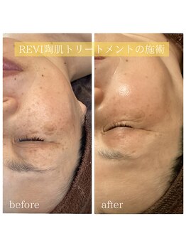 ソーレ(Sole)/REVIの陶肌トリートメント