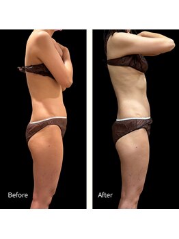 クールヴィラ(Cool Villa)/冷却4カップ+テスラ通放題1ヶ月