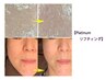 【ほうれい線/たるみ/シワ改善】Platinumリフティング45分×10回コース