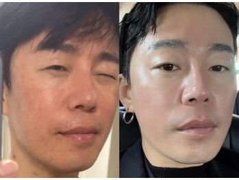 ユニ(Uni)/インセルダム 男性例