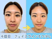 ナチュラルパーフェクトフェイス 新宿/4回目・フェイスライン/新宿小顔