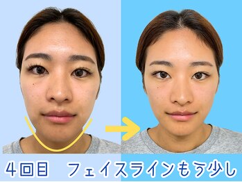 ナチュラルパーフェクトフェイス 新宿/4回目・フェイスライン/新宿小顔