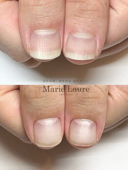 マリーロール 梅田店(Marie Laure)/自爪育成/深爪矯正/ネイルケア