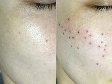 しらゆき 名古屋黒川/ターンオーバーと共にポロっと