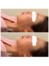 ウィズ ユー ビューティ(with U beauty)/顎下シュッと