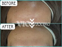 ヴィオワクシング(VIO WAXING)/【不死化幹細胞】フェイシャル