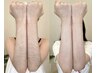 【選べる部分脱毛】Mパーツ部分脱毛◇気になる部分だけ♪都度払い