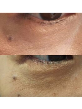 アリュール(Allule)/目の周りのお悩みにも