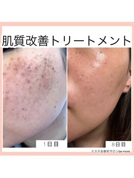 ビーモア(be more)/肌質改善光トリートメント