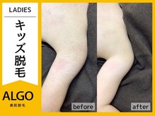 アルゴ 福井店(ALGO)/小学生女の子 腕脱毛 8回目