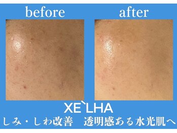 パールホワイトニング/セラピールでしみ/しわ改善