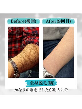ナンバーフォー 池尻大橋(No.4)/Before & After (腕)