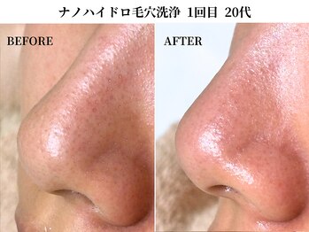 サンビ(SANBI)/鼻の黒ずみ皮脂は任せください！