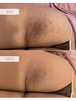 ケイ(K)/《防府》お尻のニキビ・黒ずみ