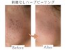 【にきび/跡/シミ/毛穴】剥離なしハーブピーリング