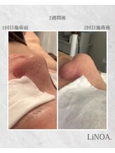 LiNOA./毛穴2週間後、サロンケア2回