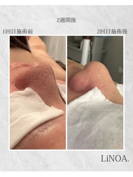LiNOA./毛穴2週間後、サロンケア2回
