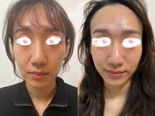 ヒメ ビューティー(Hime beauty)の雰囲気(ピーリング+ハイパーナイフ+美白パック 一回)