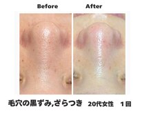 ラナン パラフューズ(Ranun's PARAFUSE.)/毛穴ビフォーアフター（1）