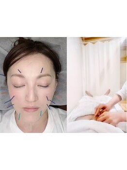 鍼灸施術を受けたい