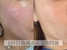 【脱くすみ肌！ワントーン明るい肌に】ダウンタイムなしスペシャル  ¥10000