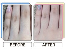 ストラッシュ 藤沢店(STLASSH)/施術例：指先