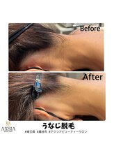 アクシア ビューティー サロン(AXSIA)/【うなじ脱毛BeforeAfter】