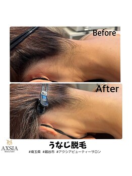 アクシア ビューティー サロン(AXSIA)/【うなじ脱毛BeforeAfter】