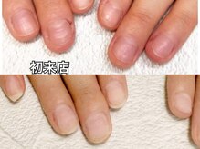 グレースレディ/矯正から育爪へ