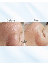 サロン モウ(mou。)/毛穴黒ずみ