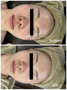 ジャスミン(Jasmin)/ダブルピール×イオン導入