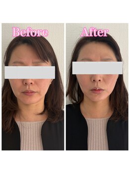 ヨウキ(YOKI)/ほうれい線も薄くなります◎