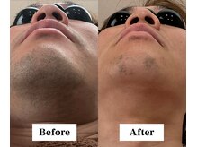 ワイイーサロン(Y/E SALON)/【30代男性　ヒゲ脱毛】