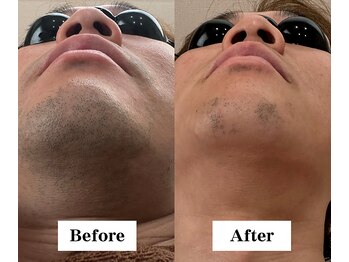 ワイイーサロン(Y/E SALON)/【30代男性　ヒゲ脱毛】