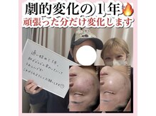 ホワイトアクア 天王寺本店(WHITE AQUA)/ハーブピーリング/大阪/天王寺