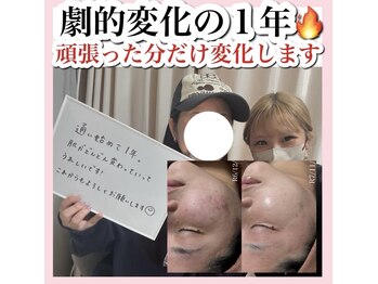 ホワイトアクア 天王寺本店(WHITE AQUA)/ハーブピーリング/大阪/天王寺