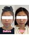 ヴィヴィアナ(viviana)の写真/都度払いOK◎気になるフェイスラインをすっきり整えたい方におすすめ!
